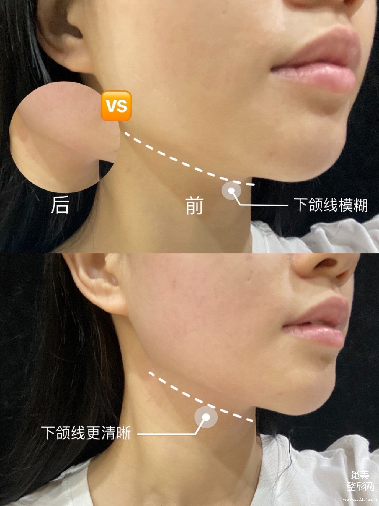 fotona 4d和热玛吉有区别吗?Fotona 4D Pro有没有副作用?案例解析