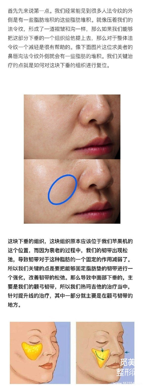 什么年龄适合做热玛吉?热玛吉去法令纹*果好吗?