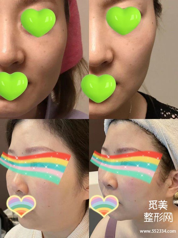 什么年龄适合做热玛吉?热玛吉去法令纹*果好吗?