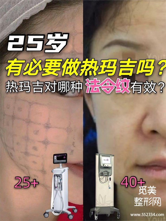 什么年龄适合做热玛吉?热玛吉去法令纹*果好吗?
