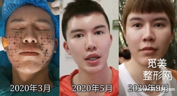 什么年龄适合做热玛吉?热玛吉去法令纹*果好吗?