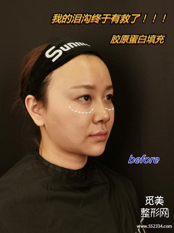 昆明泪沟填充|双美胶原蛋白祛泪沟黑眼圈,我的泪沟终于有救了!!!