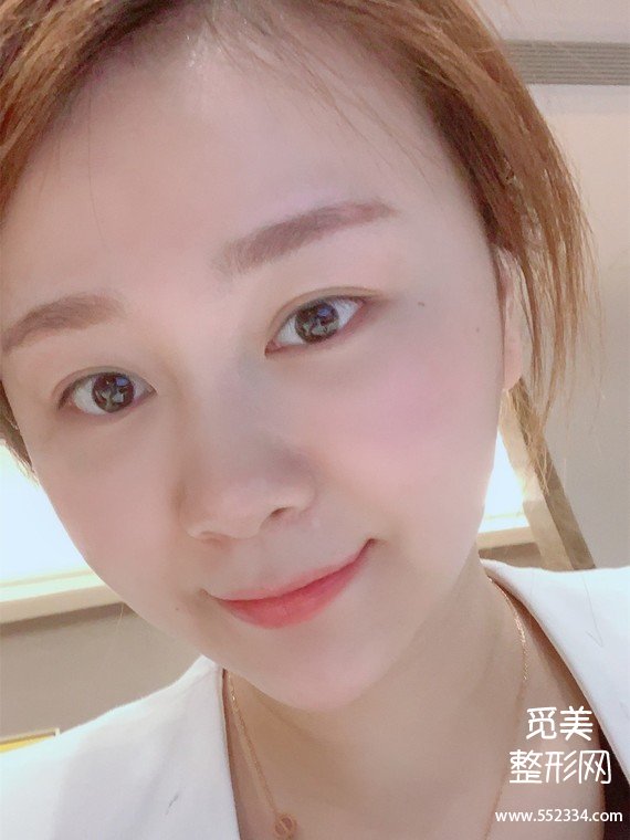 昆明泪沟填充|双美胶原蛋白祛泪沟黑眼圈,我的泪沟终于有救了!!!