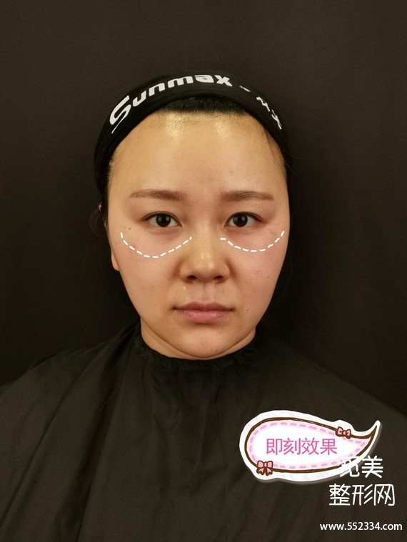 昆明泪沟填充|双美胶原蛋白祛泪沟黑眼圈,我的泪沟终于有救了!!!