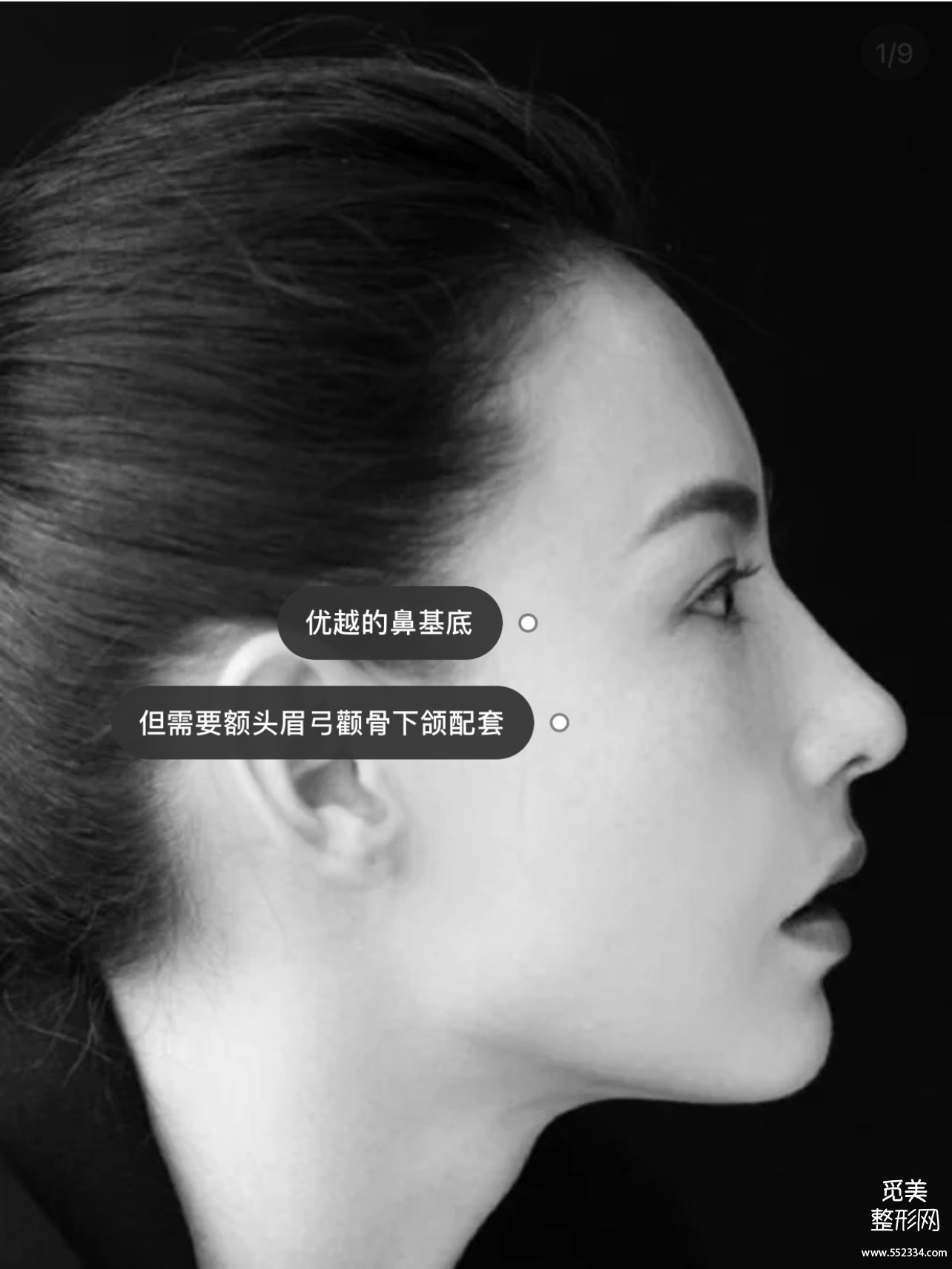 千万不要做鼻基底!!鼻基底填充*果好吗?