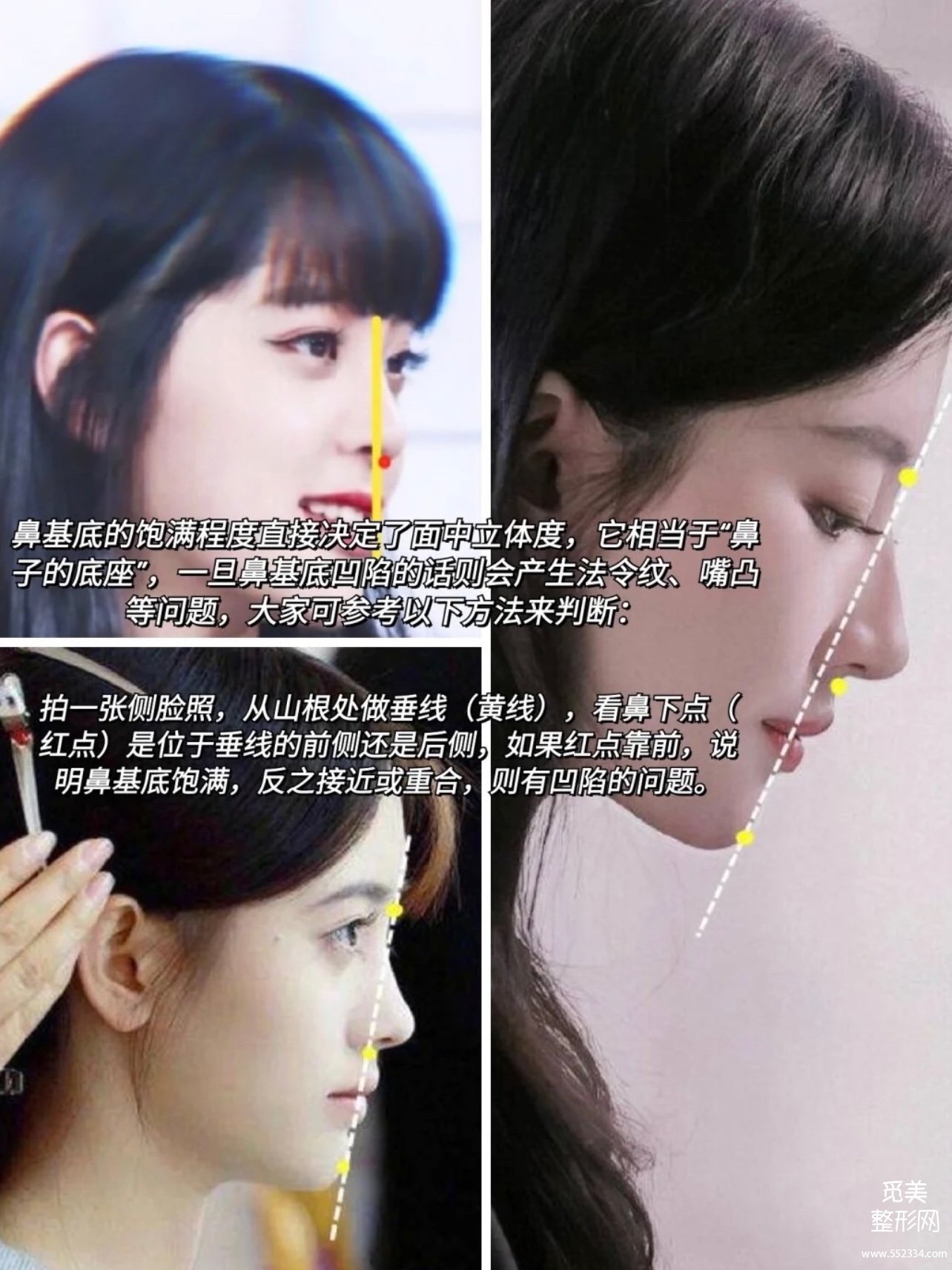 千万不要做鼻基底!!鼻基底填充*果好吗?