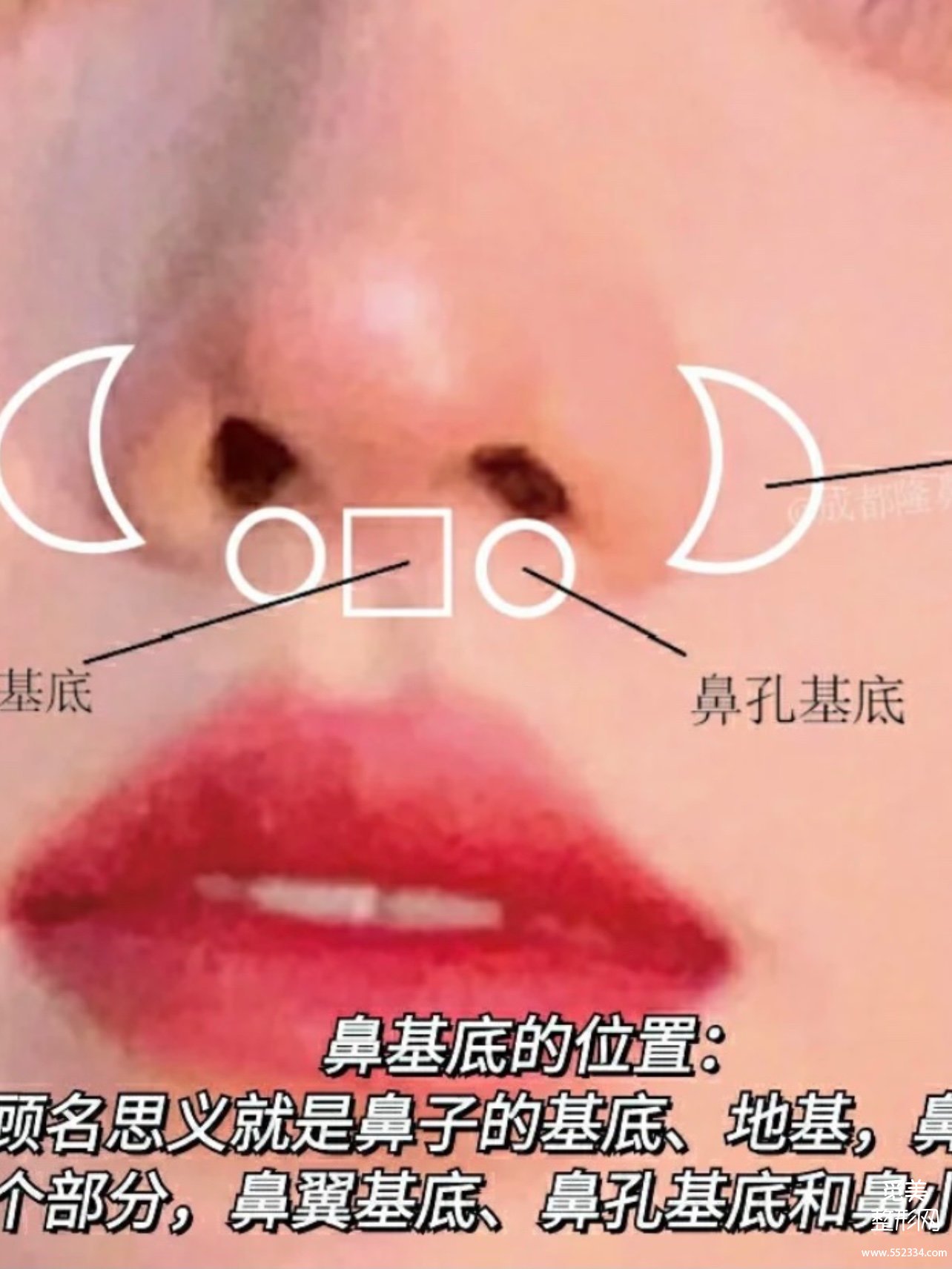 千万不要做鼻基底!!鼻基底填充*果好吗?