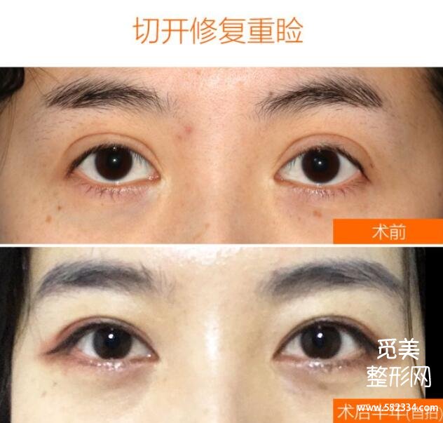 国内双眼皮修复*厉害的医生排名:宽改窄肉条疤痕修复