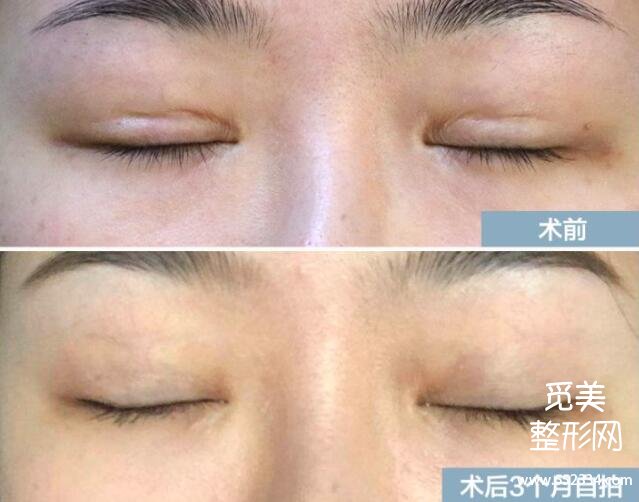 国内双眼皮修复*厉害的医生排名:宽改窄肉条疤痕修复