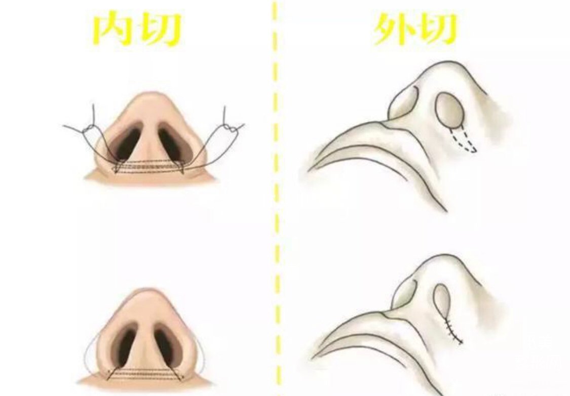 福州做缩鼻翼手术哪家医院好?福州鼻翼缩小医院排名