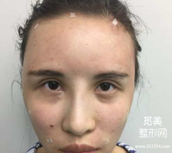 长春面部脂肪填充哪个医院好?案例?长春中妍、吉林铭医、长春西之米