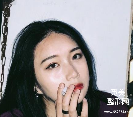 保定蓝山杜建龙做鼻子怎么样?杜建龙双眼皮案例分析