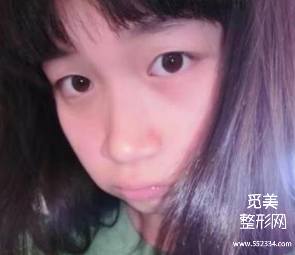保定蓝山杜建龙做鼻子怎么样?杜建龙双眼皮案例分析