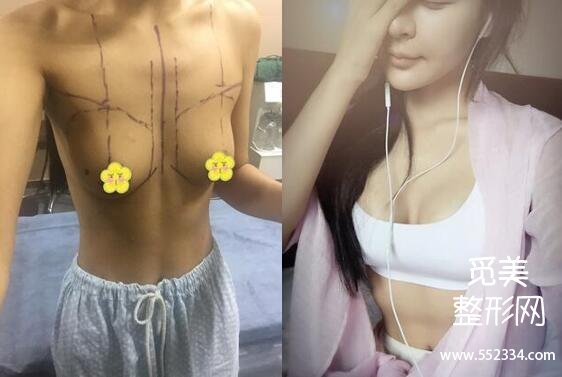 生完孩子感觉胸下垂怎么办?乳房下垂矫正手术怎么做?