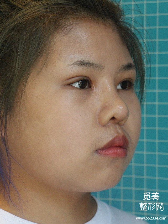 哈尔滨隆鼻案例,缩小鼻翼鼻头+垫鼻梁,这*果值吗?