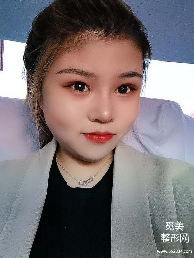 哈尔滨隆鼻案例,缩小鼻翼鼻头+垫鼻梁,这*果值吗?