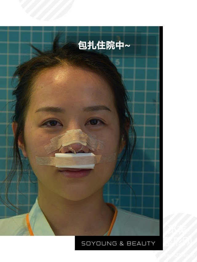 青岛隆鼻案例,鼻翼变小鼻梁变高*果满意!