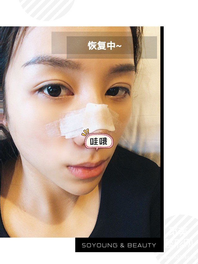 青岛隆鼻案例,鼻翼变小鼻梁变高*果满意!
