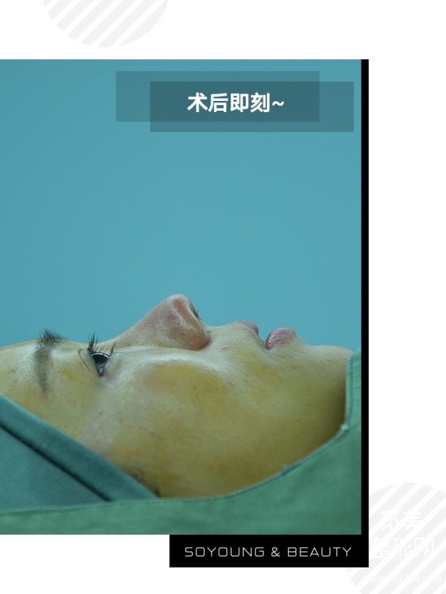 青岛隆鼻案例,鼻翼变小鼻梁变高*果满意!