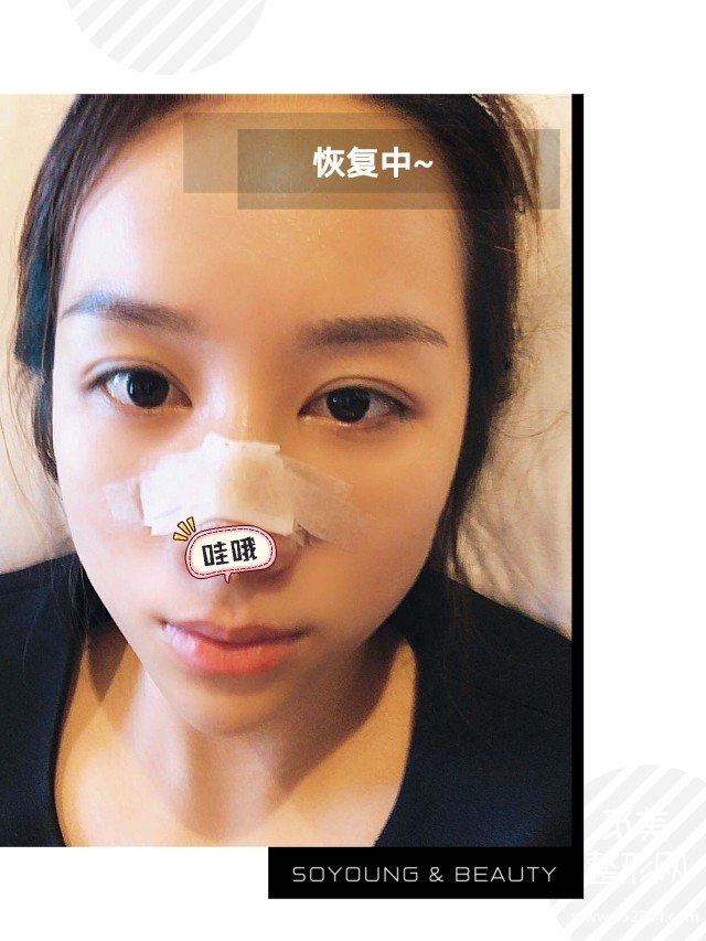 青岛隆鼻案例,鼻翼变小鼻梁变高*果满意!