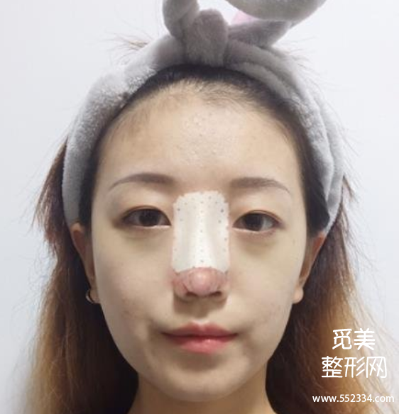 上海隆鼻排行前三的医生!戴传昌、谢卫国、赵延峰附隆鼻案例!