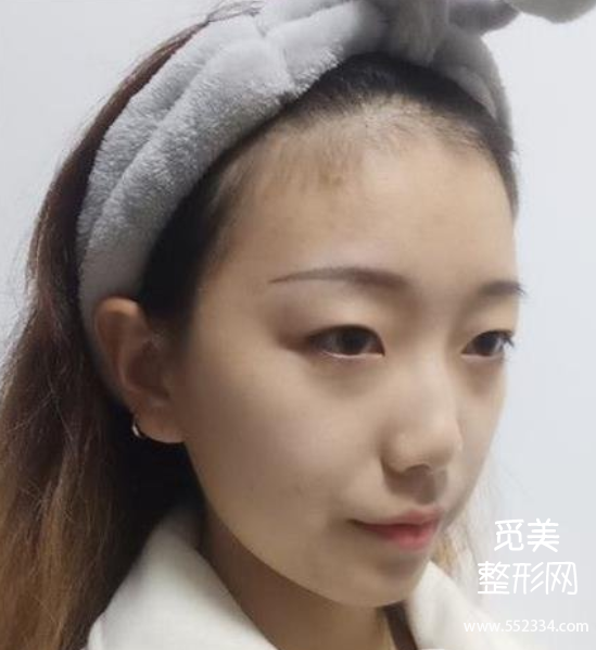 上海隆鼻排行前三的医生!戴传昌、谢卫国、赵延峰附隆鼻案例!