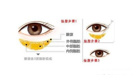 祛眼袋手术费用大概多少钱?割眼袋***有*的方法