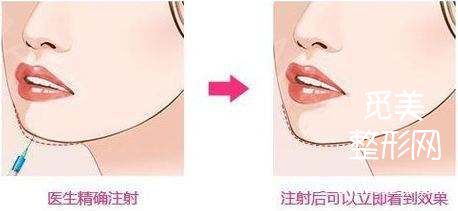 垫下巴什么方式**?下巴整形后遗症有哪些?
