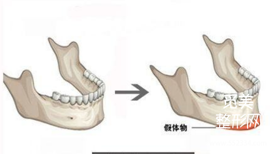 垫下巴什么方式**?下巴整形后遗症有哪些?