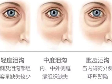 填充泪勾能维持多久?填充泪沟多少多少钱?