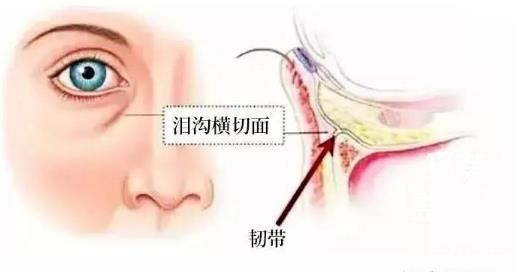 填充泪勾能维持多久?填充泪沟多少多少钱?
