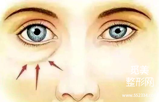 填充泪勾能维持多久?填充泪沟多少多少钱?
