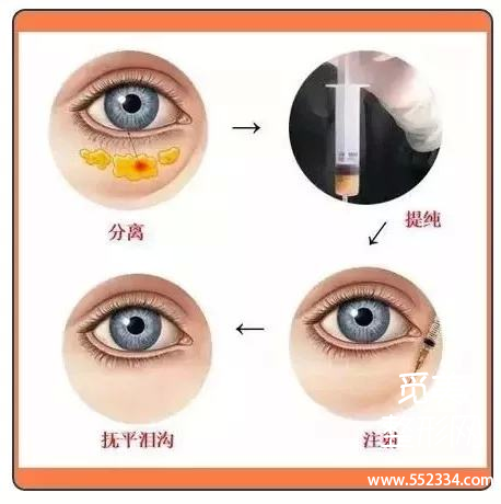 填充泪勾能维持多久?填充泪沟多少多少钱?