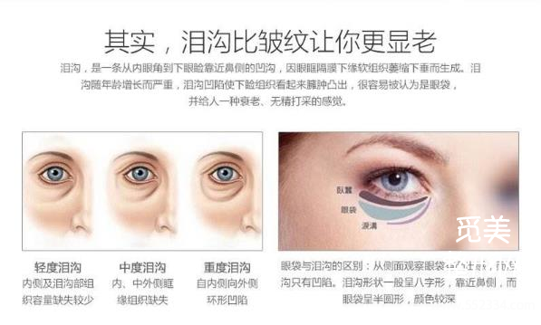 填充泪勾能维持多久?填充泪沟多少多少钱?