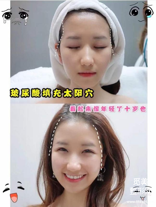玻尿酸到底有什么作用,值得做吗?