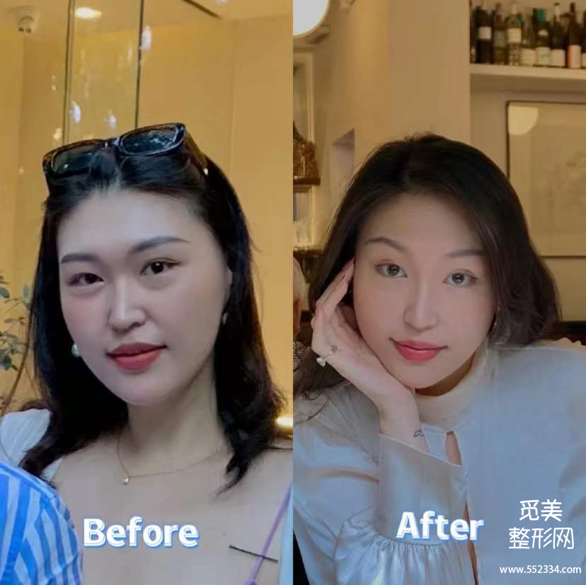 玻尿酸到底有什么作用,值得做吗?
