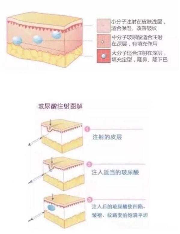 玻尿酸到底有什么作用，值得做吗？