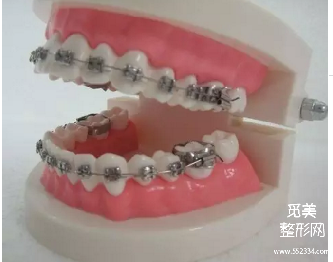 郑州牙齿矫正哪里好?大概需要多少钱?