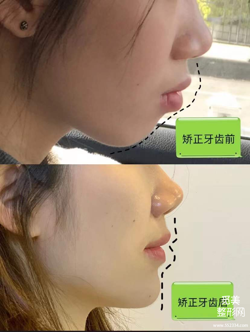 郑州牙齿矫正哪里好?大概需要多少钱?