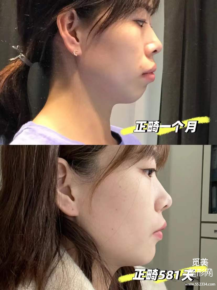 郑州牙齿矫正哪里好?大概需要多少钱?