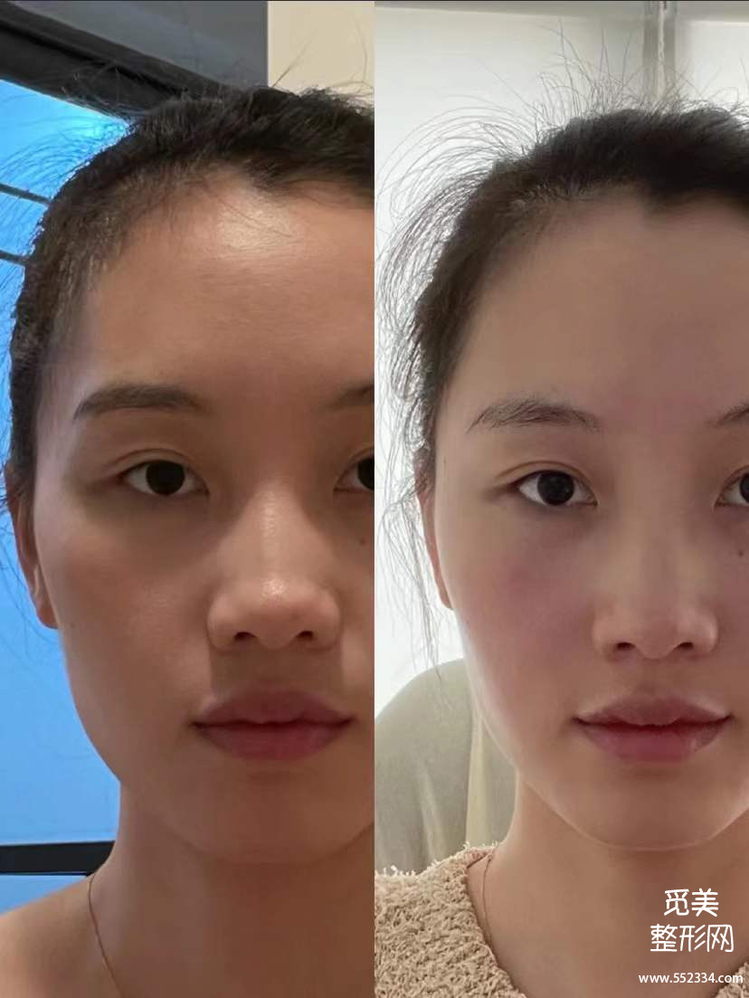 自体脂肪vs胶原蛋白是智商税吗?到底哪个填充*果好