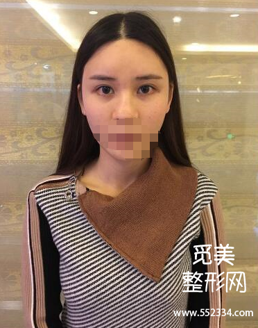上海谢卫国隆鼻怎么样?大概多少钱?
