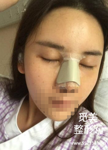 上海谢卫国隆鼻怎么样?大概多少钱?