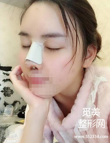 上海谢卫国隆鼻怎么样?大概多少钱?