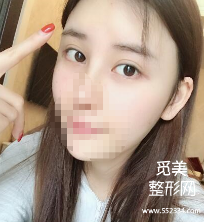 上海谢卫国隆鼻怎么样?大概多少钱?