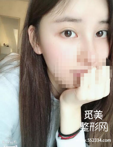 上海谢卫国隆鼻怎么样?大概多少钱?