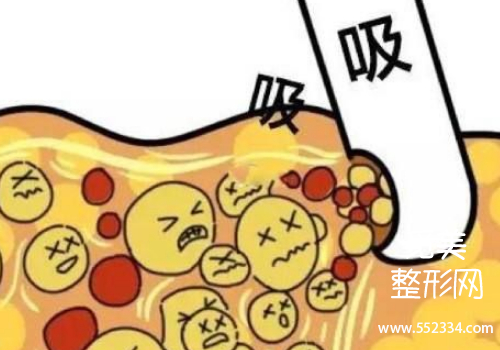 北京东方协和冯斌大腿吸脂怎么样?大概多少钱?