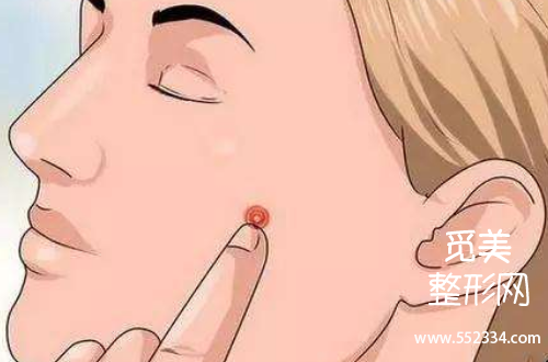 杭州点阵激光去痘印哪个医院好?费用大概是多少?