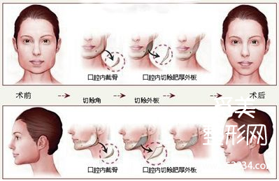 南京下颌角磨骨医院口碑测评,排名前三重磅来袭!