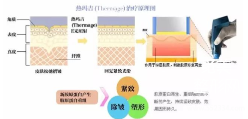 上海九院口碑怎么样?热玛吉哪个医生做得好?